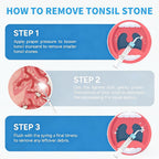 Tonsil Stone Remover with 1080P HD Camera - Visual Removal Kit 6 LED Lights 5 Stainless Tips USB Rechargeable iOS Android App Oral Care Tool